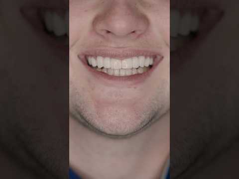 Veneer makeover at Smile Texas! 💥 #dental #cosmeticdentistry #dentalimplantsnearme #dentist