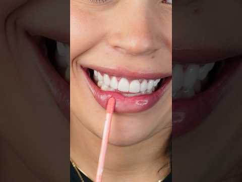 CORRECTING A GUMMY SMILE 🌟🦷 #veneers #dentalveneers #smiledental #cosmeticdentistry #dentist